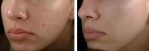 laseroterapia-przed-po laseroterapia-przed-po