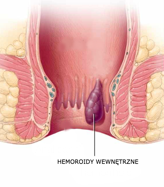 hemoroidy-wewnetrzne