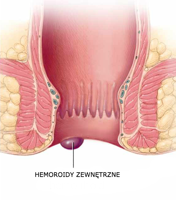 hemoroidy-zewnetrzne